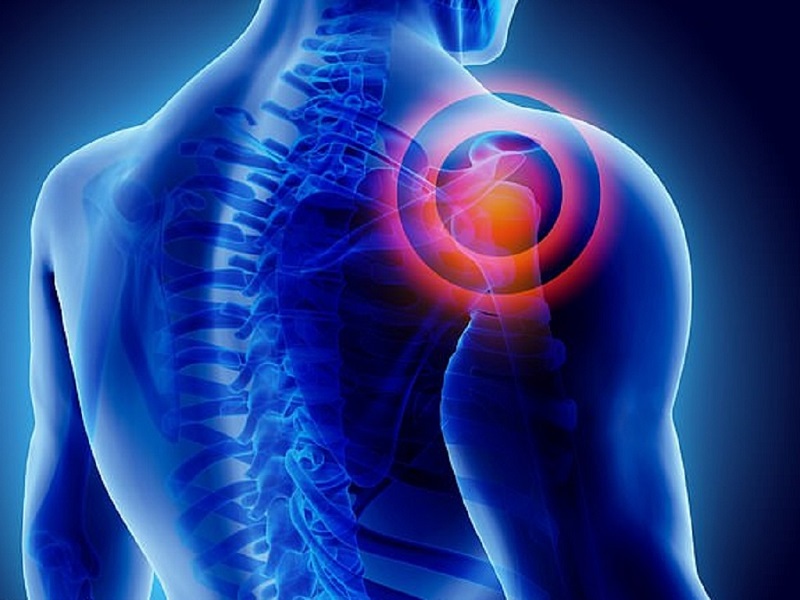 Bệnh viêm quanh khớp vai tiến triển âm thầm, ban đầu đau ít nhưng tăng dần