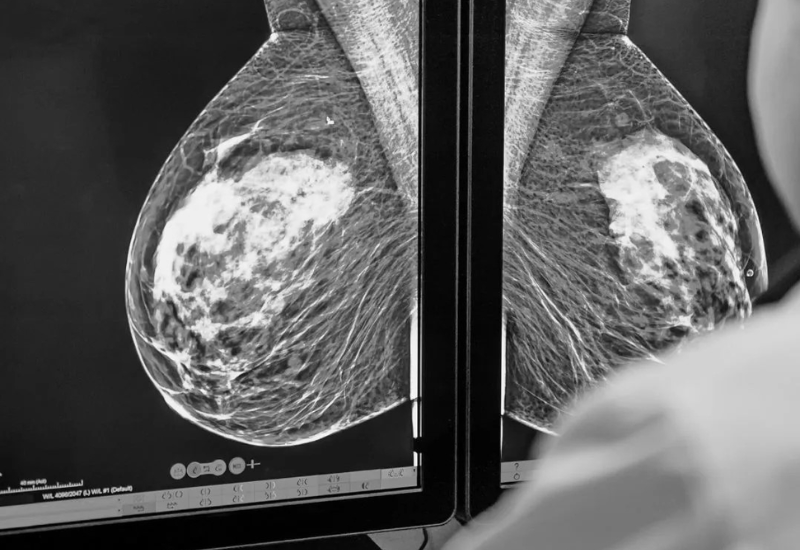 Chụp nhũ ảnh giúp phát hiện sớm các tổn thương ở vùng vú 