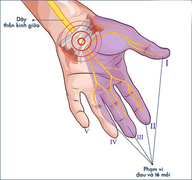 Hội chứng ống cổ tay là bệnh lý của dây thần kinh giữa khi bị chèn ép trong ống cổ tay. Ảnh minh họa