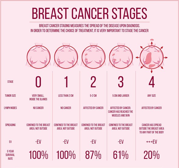 Các giai đoạn của ung thư vú và tiên lượng