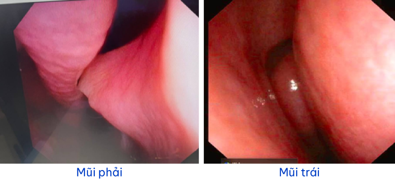 Bất thường tại mũi phải được phát hiện trên hình ảnh nội soi tai mũi họng ống mềm