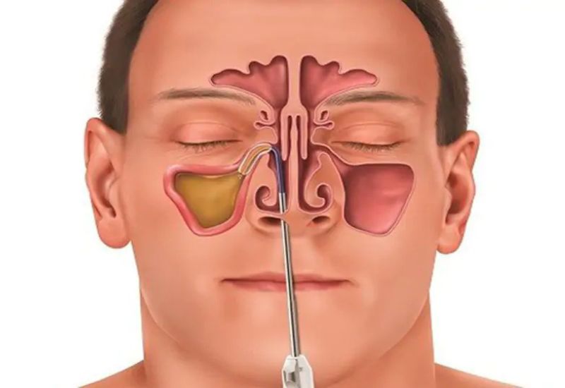 Phẫu thuật điều trị viêm xoang sàng