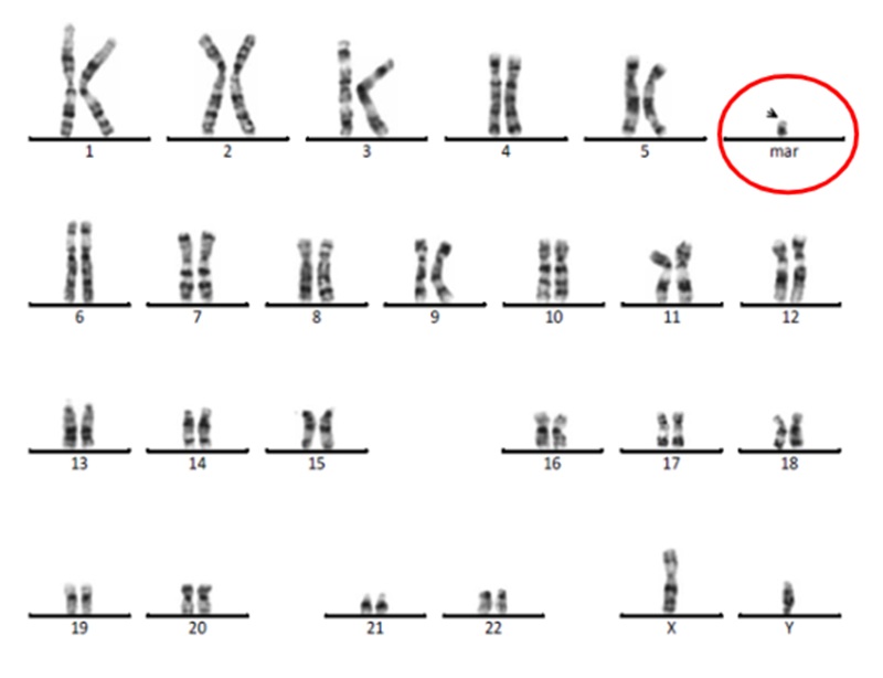 Tế bào bất thường của bệnh nhân được phát hiện qua xét nghiệm nhiễm sắc thể đồ