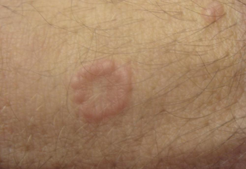 Bệnh lý u hạt vòng đặc trưng bởi các tổn thương trên da có dạng vòng hoặc nửa vòng