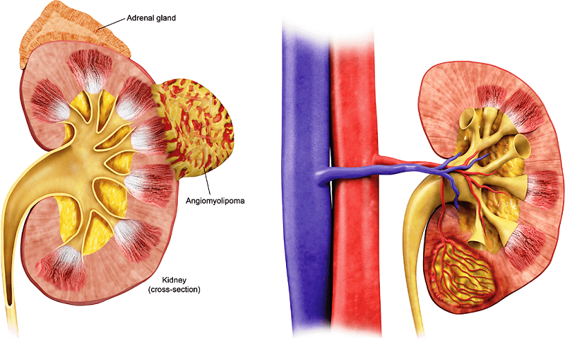 U cơ mỡ mạch thận là loại u lành tính phổ biến nhất của thận
