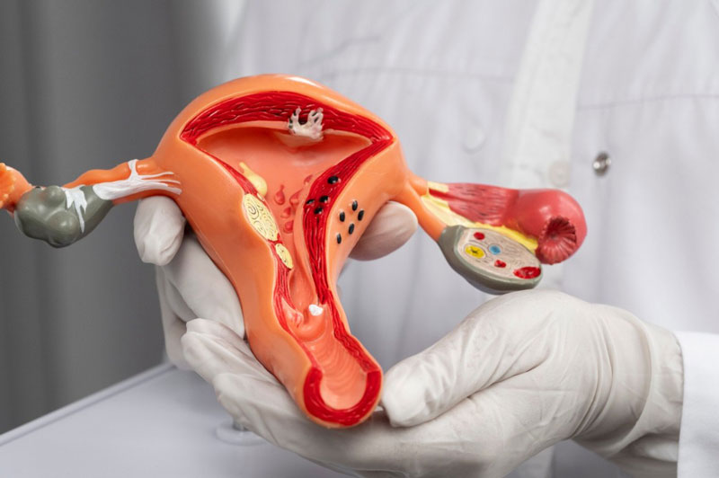 U xơ tử cung là loại u xơ thường gặp nhất