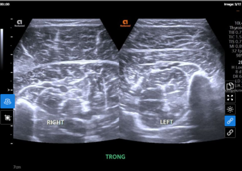 Bất thường tại chân phải được phát hiện trên hình ảnh siêu âm phần mềm  