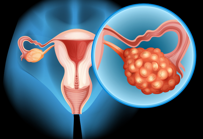 U nang về cơ bản là một túi kín có lớp màng bao rõ ràng, phát triển bất thường tại nhiều vị trí khác nhau trên cơ thể