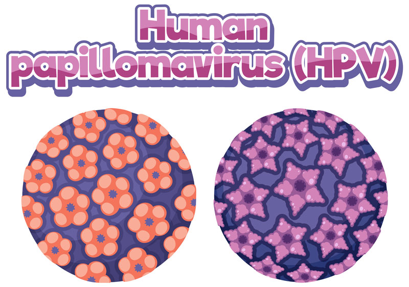 Tình trạng nhiễm virus HPV là nguyên nhân hàng đầu dẫn đến u nhú ở miệng 
