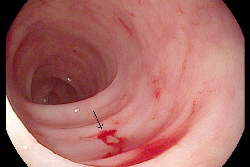 Hình ảnh nội soi viêm loét đại tràng chảy máu