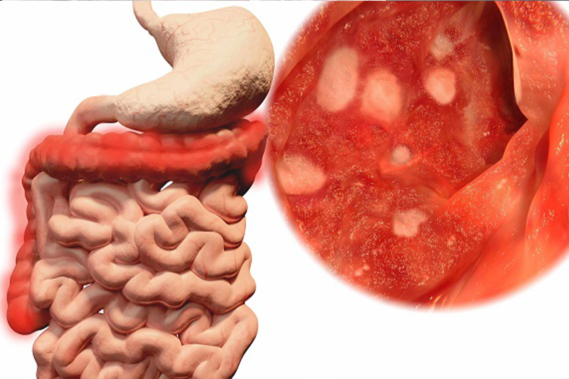 Viêm loét đại tràng chảy máu