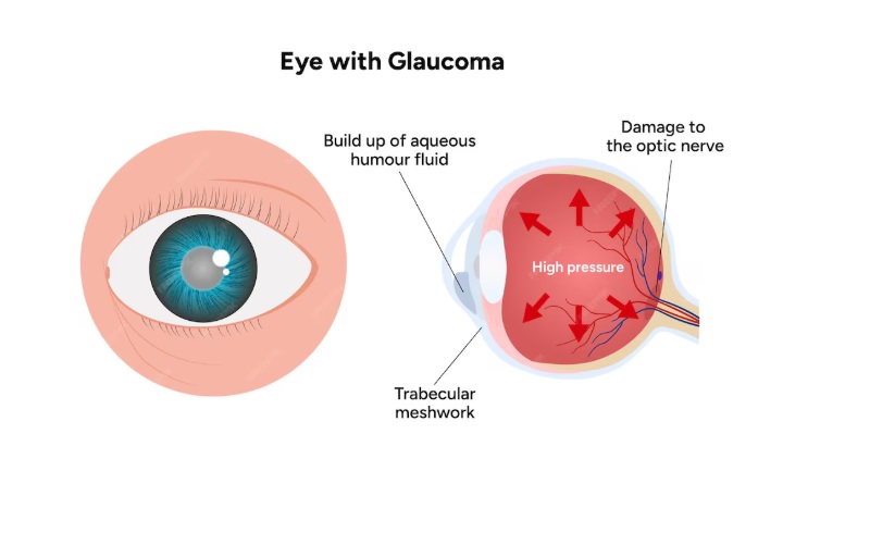 Hình ảnh mô phỏng bệnh cườm nước (Glaucoma)