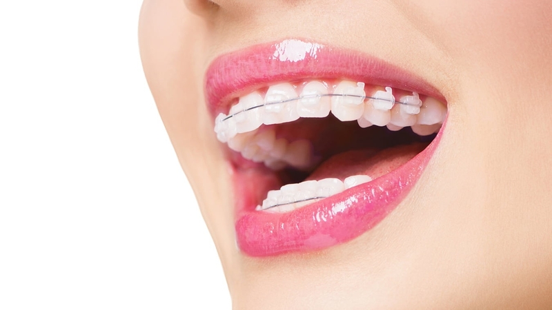 Niềng răng là một trong những biện pháp điều trị răng móm