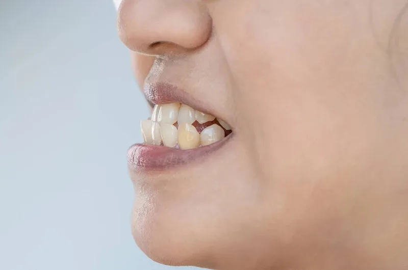 Răng móm gây ảnh hưởng tới thẩm mỹ