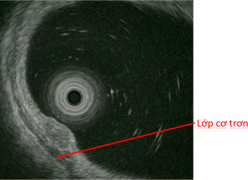 Khối u tại đại tràng dưới hình ảnh nội soi siêu âm 