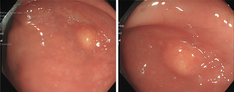 Hình ảnh khối u tại đại tràng có kích thước khoảng 1cm 