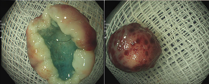 Hình ảnh khối u sau khi được cắt bỏ 