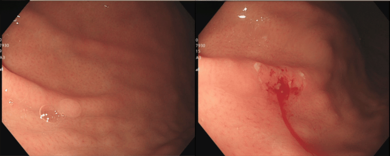 Hình ảnh polyp kích thước khoảng 0,3cm tại thân vị dạ dày 