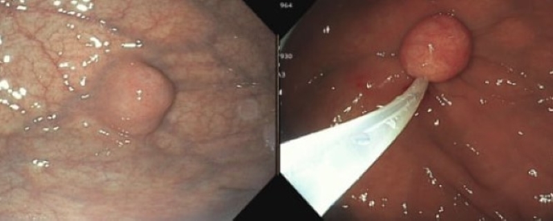 Bất thường tại dạ dày được phát hiện trên hình ảnh nội soi  