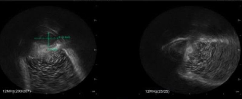 Bệnh nhân được chỉ định thực hiện chẩn đoán chuyên sâu bằng kỹ thuật nội soi siêu âm hiện đại  