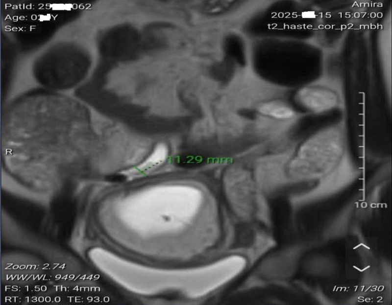 Hình ảnh chụp cộng hưởng từ cho thấy có sỏi phân tại gốc ruột thừa 