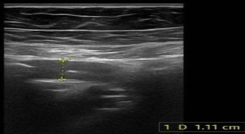 Siêu âm phát hiện ruột thừa ở vùng hố chậu phải, có đường kính khoảng 11mm 