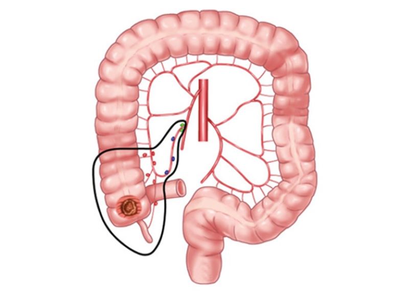 U manh tràng có thể tiến triển thành ung thư manh tràng