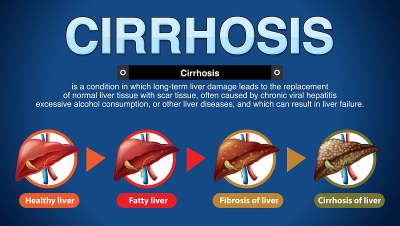 Làm sạch gan nhiễm mỡ giúp ngăn ngừa nguy cơ tiến triển xơ gan