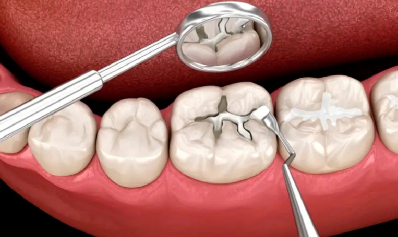 Với độ an toàn cao và khả năng phục hồi tốt, trám răng là lựa chọn phù hợp trong điều trị các trường hợp răng sâu