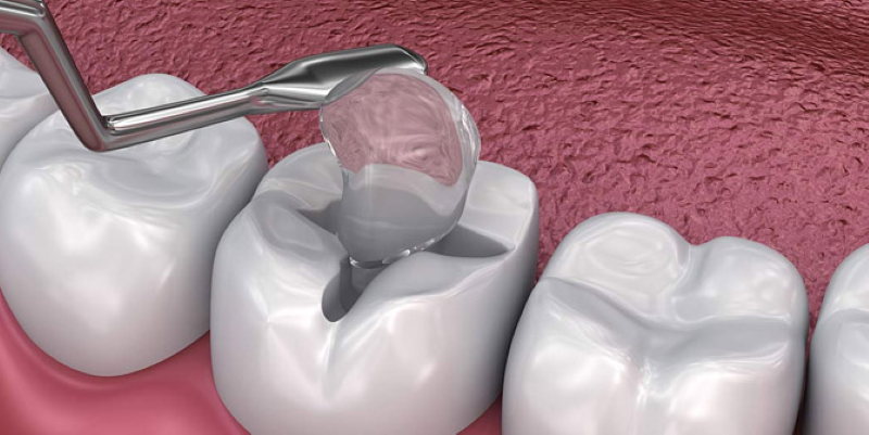 Trám răng sâu lỗ to bao nhiêu tiền - câu trả lời phụ thuộc vào nhiều yếu tố 