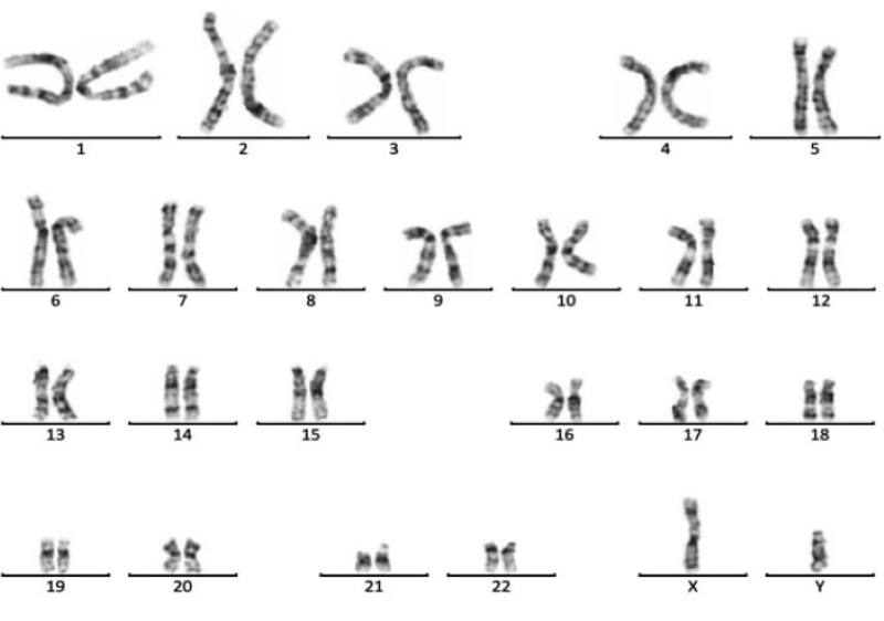 Kết quả xét nghiệm nhiễm sắc thể của bệnh nhân               
