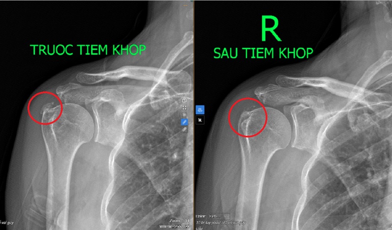 Ổ vôi hóa ở khớp vai phải của bệnh nhân đã giảm rõ rệt sau khi được làm thủ thuật 