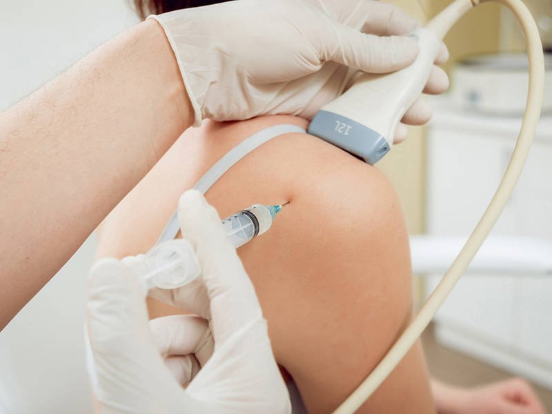 Phương pháp chọc hút rửa vôi hóa qua da (barbotage) là phương pháp can thiệp tối thiểu nhưng mang lại hiệu quả cao. Ảnh minh họa 