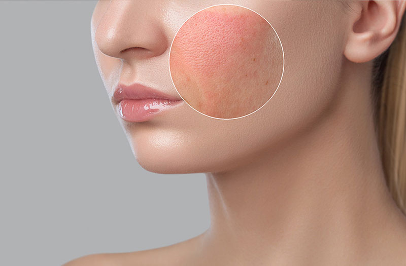Những loại mỹ phẩm nào có thể gây dị ứng nổi mạn đỏ trên da mặt?
