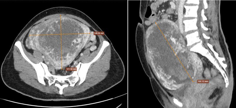 CT Scanner thấy tử cung kích thước lớn nhưng không thấy hình ảnh túi thai (ảnh phải); bên trong có hình ảnh đặc trưng dạng “bọt xà phòng” (ảnh trái)