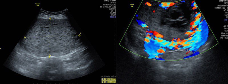 Siêu âm thấy vùng hạ vị của bệnh nhân xuất hiện khối cấu trúc hỗn hợp âm, kèm tăng sinh mạch rõ trên siêu âm Doppler