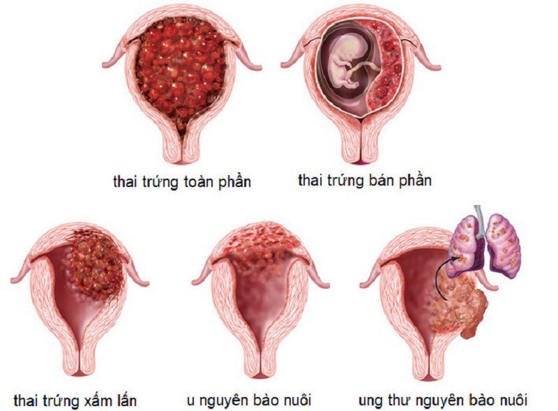 Thai trứng là bệnh lý tăng sinh bất thường của tổ chức nguyên bào nuôi, có nguy cơ gây nhiều biến chứng nguy hiểm
