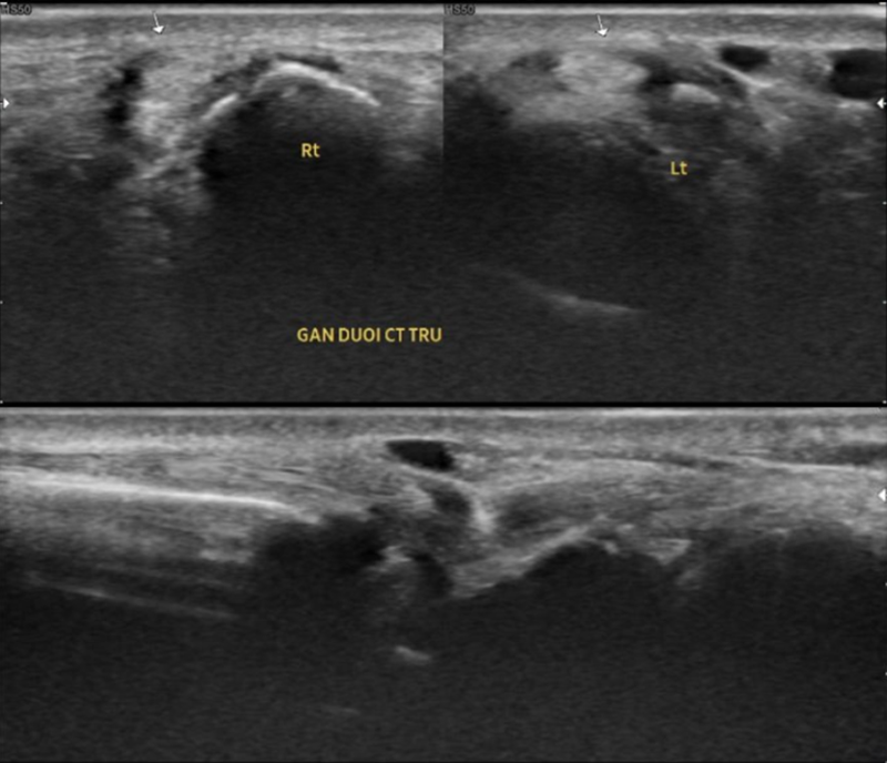 Siêu âm khớp cổ tay trái cho thấy hình ảnh gân duỗi cổ tay trụ trái phù nề nhẹ