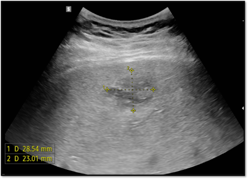 Trên siêu âm phát hiện hình ảnh ổ dịch hỗn hợp âm gan phải, theo dõi áp xe gan
