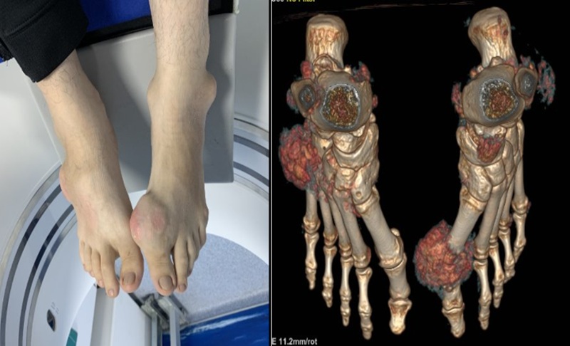 Hình ảnh lắng đọng tinh thể urat lan tỏa tại bao hoạt dịch, gân cơ và phần mềm vùng cổ chân, bàn chân… qua chụp DECT