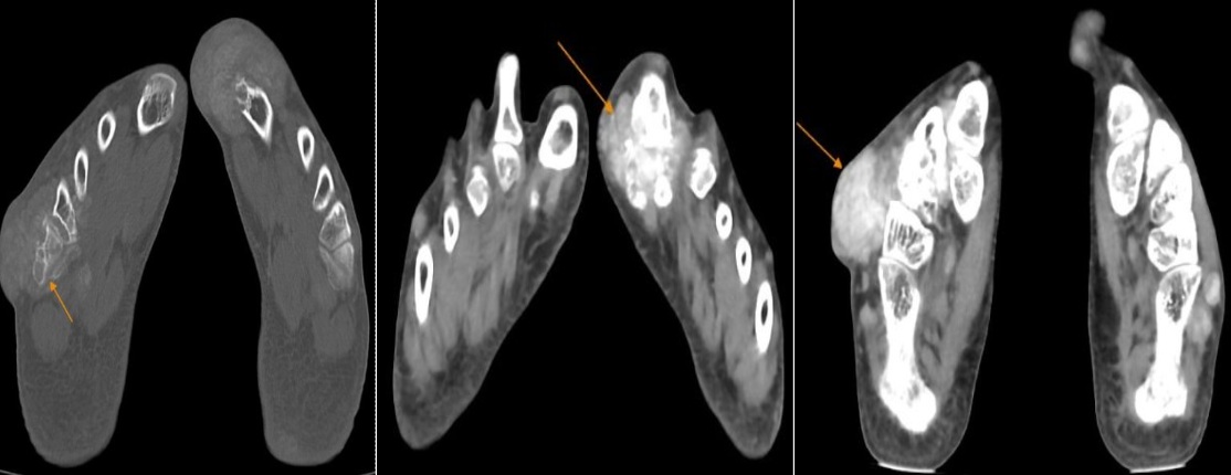 Nhiều ổ tiêu xương tại cổ chân, xương bàn – ngón và xương chêm hai bên của bệnh nhân