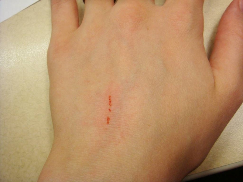 HIV có lây qua vết xước nhỏ không còn phụ thuộc vào tính chất của vết xước