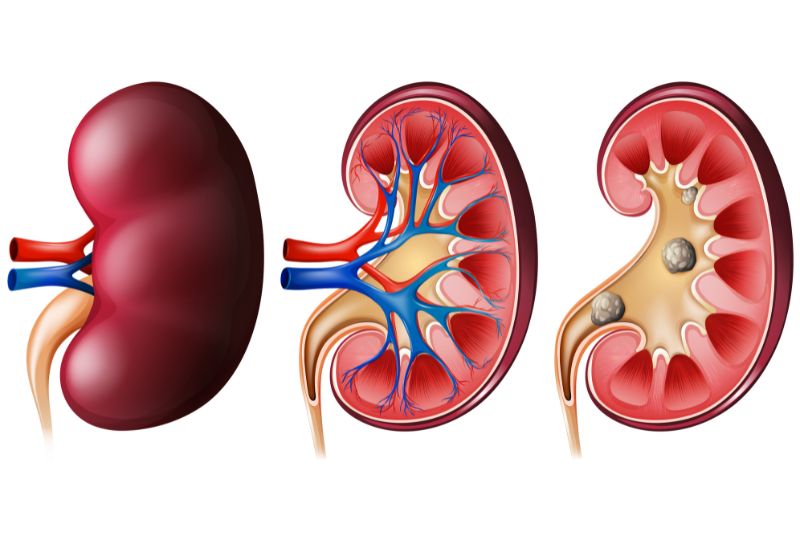 Đa số sỏi thận có thể phát hiện thông qua hình ảnh siêu âm