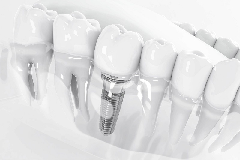 Cấy ghép răng bằng implant là phương pháp giúp phục hồi chức năng ăn nhai gần giống với răng thật.