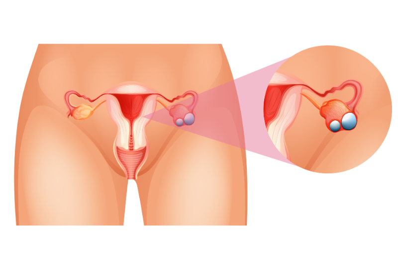 U nang buồng trứng thường phát triển chậm và có thể không gây triệu chứng rõ ràng trong giai đoạn đầu