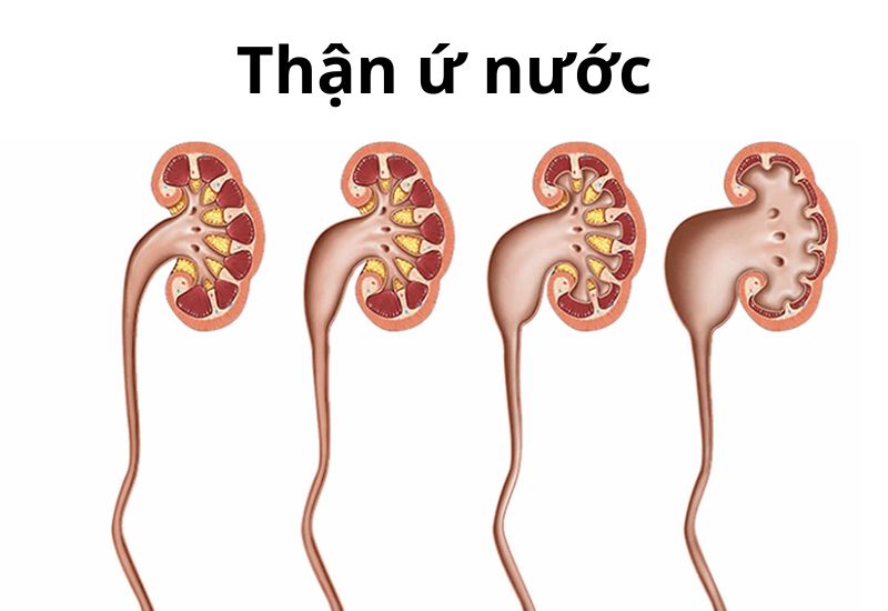 Hình ảnh thận ứ nước qua các giai đoạn tiến triển
