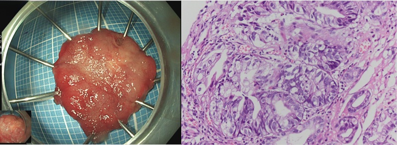 Kết quả giải phẫu bệnh sau ESD cho biết tổn thương tại góc bờ cong nhỏ dạ dày là loạn sản biểu mô tuyến độ cao 