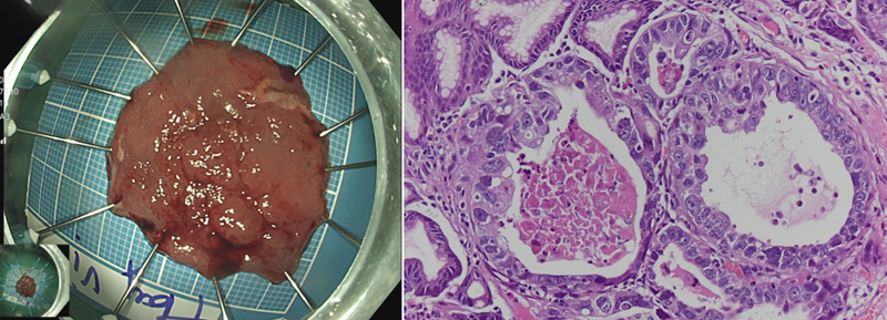 Kết quả giải phẫu bệnh sau ESD phát hiện tổn thương tại hang vị dạ dày là carcinoma tuyến biệt hóa vừa xâm nhập mô đệm trong niêm mạc (pT1a) 