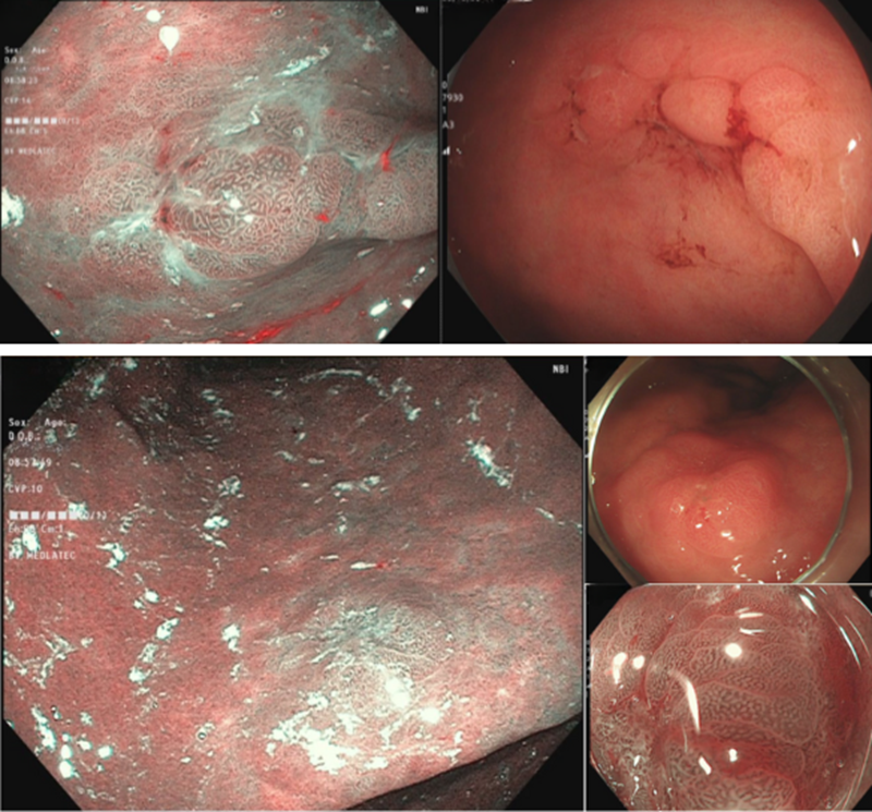 Hình ảnh tổn thương tại hang vị dạ dày và góc bờ cong dạ dày 