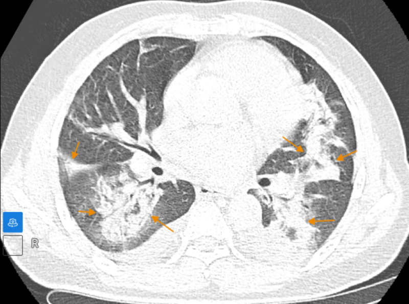 Phim chụp cắt lớp vi tính phát hiện tổn thương đông đặc nhu mô phổi   